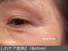 オアシスラグーン(OASIS LAGOON)/しわ改善（症例2 before）70代