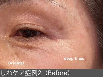 オアシスラグーン(OASIS LAGOON)/しわ改善(症例2 before)70代