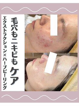 サロン リュンヌ(salon lune)/エクストラクション+ピーリング