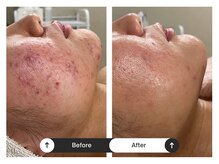 リジュ(Reje)/赤み&ニキビケア