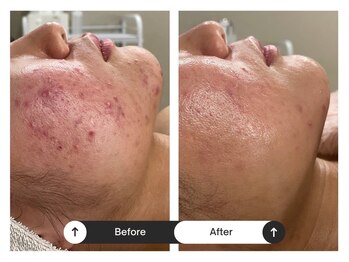 リジュ(Reje)/赤み&ニキビケア