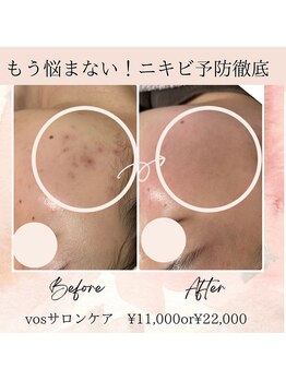 サロン ド ボーテ ラーンジュ 岐阜店(salon de beaut'e L'ange)/本気の肌改善毛穴、ニキビ、小顔