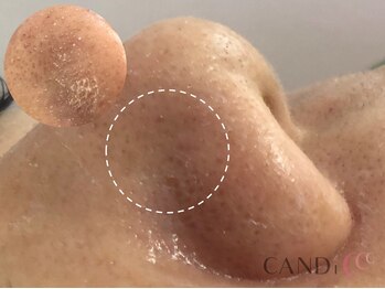 キャンディ 難波心斎橋店(CANDi)/ハイドラピーリング/黒ずみ毛穴