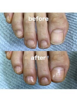 爪ケアコース
