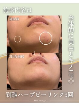 ハーブのほし/跡・美白ケア