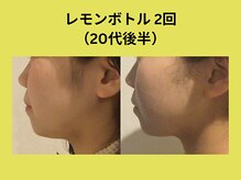 アユアランリンク 錦糸町店/レモンボトル2回