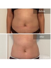 コリオ(KoRiO)/痩身5回目のお客様［狭山ヶ丘］