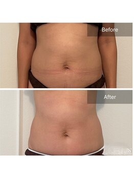 コリオ(KoRiO)/痩身5回目のお客様［狭山ヶ丘］