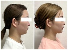 ビクシー(Bixie)/脂肪分解剤