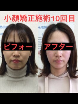 オズ六本木/六本木小顔矯正(造顔)施術10回