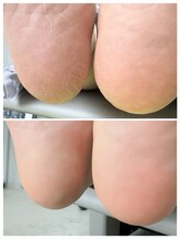 リンネ(Rinne)/角質ケアbefore→after