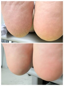 リンネ(Rinne)/角質ケアbefore→after