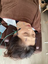 ハリファ鍼灸院 横浜関内院(HariFa鍼灸院)/美容鍼施術/美容鍼
