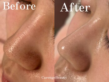 カレンジェビューティー(CarengeBeauty)/ハイドラ水光ピーリング