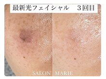 【最新光 フェイシャル】シミ改善◎