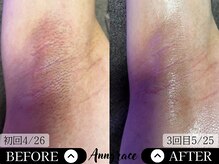 アングレイス(Anngrace)/【全身脱毛ワキ】Before/After