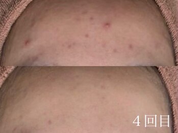 ホワイトアクア 鹿児島店(WHITE AQUA)/ハーブピーリング/鹿児島/荒田