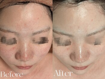 ウィハナ(wehana)/【ララピール】赤みケア/透明感