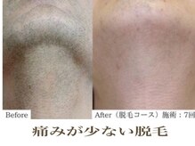 パール(PEARL)/人気最強の髭脱毛！！