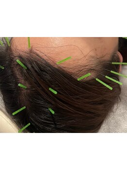 鍼灸施術を受けたい