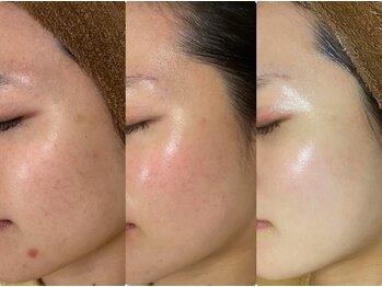 ミニョン(mignon)/ハイドラ+ハーブピーリング