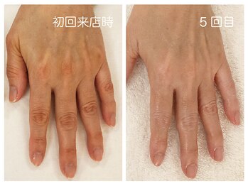 キレイテ 福岡天神店/40代/5回目【博多ハンドケア】