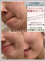 ハーバリー ハーブピーリング 栄(HERBERRYハーブピーリング) 大人気!剥離あり◎リベルハーブピーリングの効果がスゴイっ!!