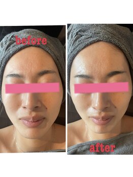 ダリア(Dahlia)/ハーブピーリング