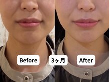 ホープ鍼灸整骨院/12回施術後！