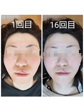 美藤鍼灸院/美容鍼のBefore After