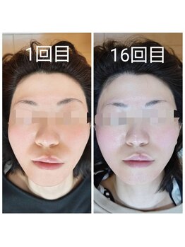 美藤鍼灸院/美容鍼のBefore After