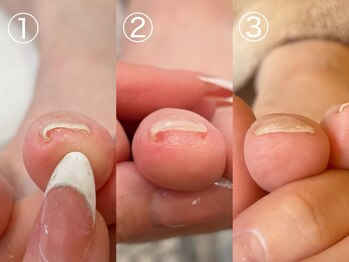 キラネイル アンド アイラッシュ by World Beauty(KIRA)/巻爪補正 ペディグラス