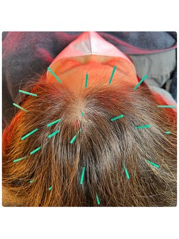 メディカルジャパン 吉祥寺/自律神経に対する頭皮鍼