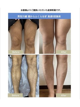 ノエ(Noe)/男性足脱毛