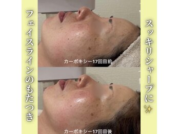 ハニエル(Haniel)/カーボキシー症例