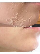 モア スキン(Mor.Skin.) 肌質改善は 当サロンへ