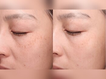 フェアリー 小松店/毛穴ニキビケアフォト美顔