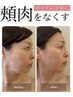 【食いしばり・たるみ・小顔】バッカルファットマッサージ60分