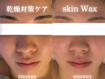 アールエーサロン 恵比寿 広尾(Ra salon)/1年のお肌変化