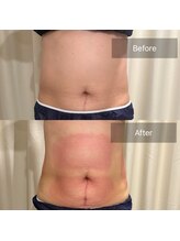 ティープラス 大和鶴間店(T-PLUS)/脂肪冷却痩身/ビフォーアフター