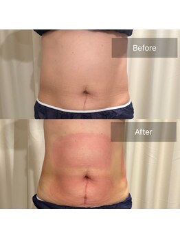 ティープラス 大和鶴間店(T-PLUS)/脂肪冷却痩身/ビフォーアフター