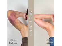 術後の女神 大阪本町店/ダウンタイムケア・インディバ