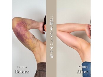 術後の女神 大阪本町店/ダウンタイムケア・インディバ