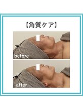 トッコ 那須塩原店(tocco)/角質ケアメニュー