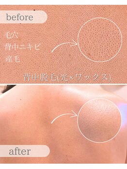 プアマヌ(PUA MANU)/背中脱毛/背中ワックス/背中毛穴