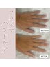 プラズマハンドトリートメントケア(手首から指先)　30分/￥3500