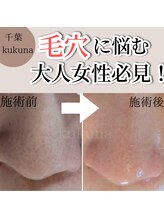 ククナ(kukuna)/月1回の毛穴ケア