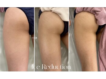 エステティックサロン フェアリー(ESTHETIC SALON FAIRLY)/痩身＊脂肪冷却ビフォーアフター