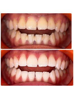 コナホワイトニング 神保町/初回ホワイトニング