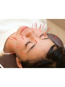 鍼灸施術を受けたい